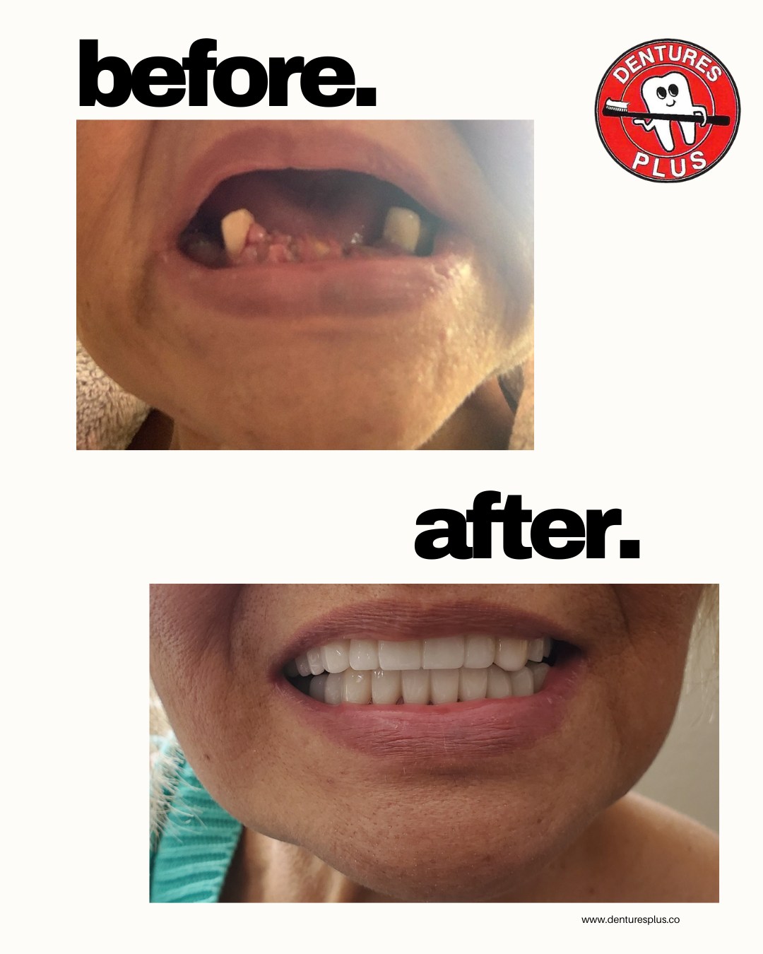 Before and after images of a patient who received partial dentures from Dentures Plus.