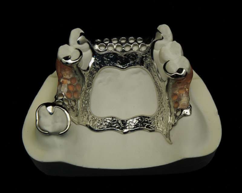 Metal partial dentures made by dentures plus for our client
