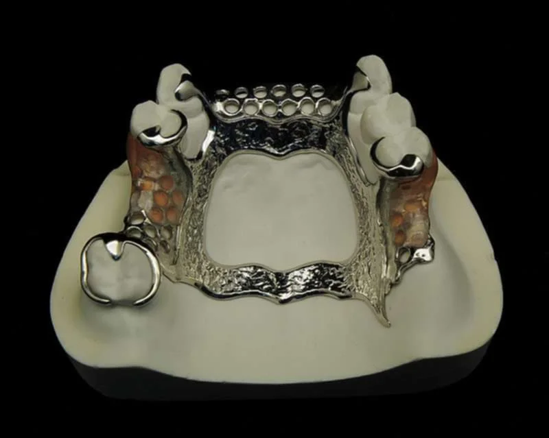 Metal partial dentures made by dentures plus for our client