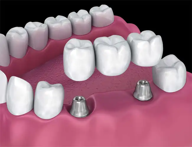 Diagram showing the process of installing dental bridges at Dentures Plus