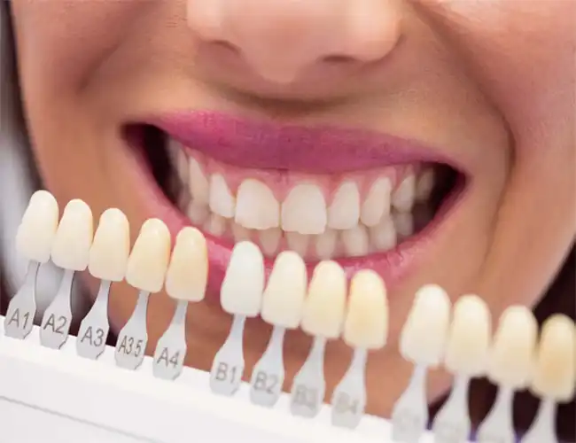 Patient showing off their new porcelain veneers from Dentures Plus.