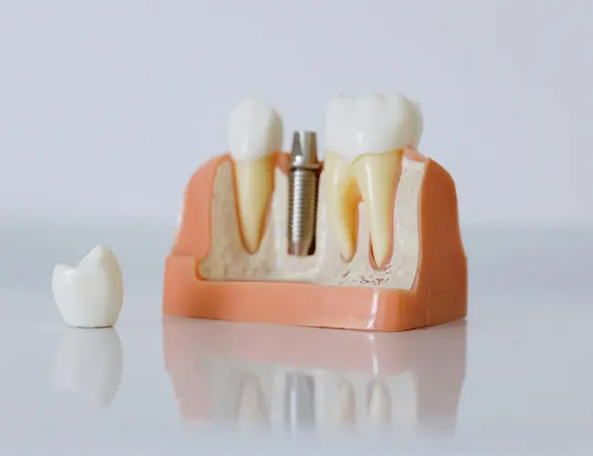 Diagram illustrating the dental implant restoration process at Dentures Plus.