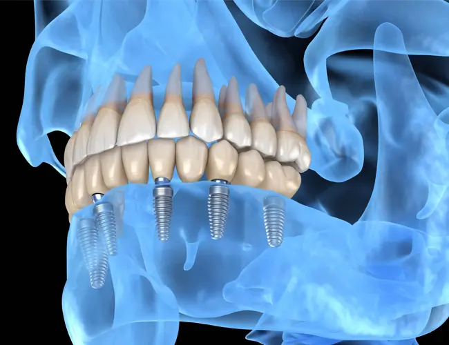 Diagram illustrating the process of a full mouth reconstruction treatment plan.
